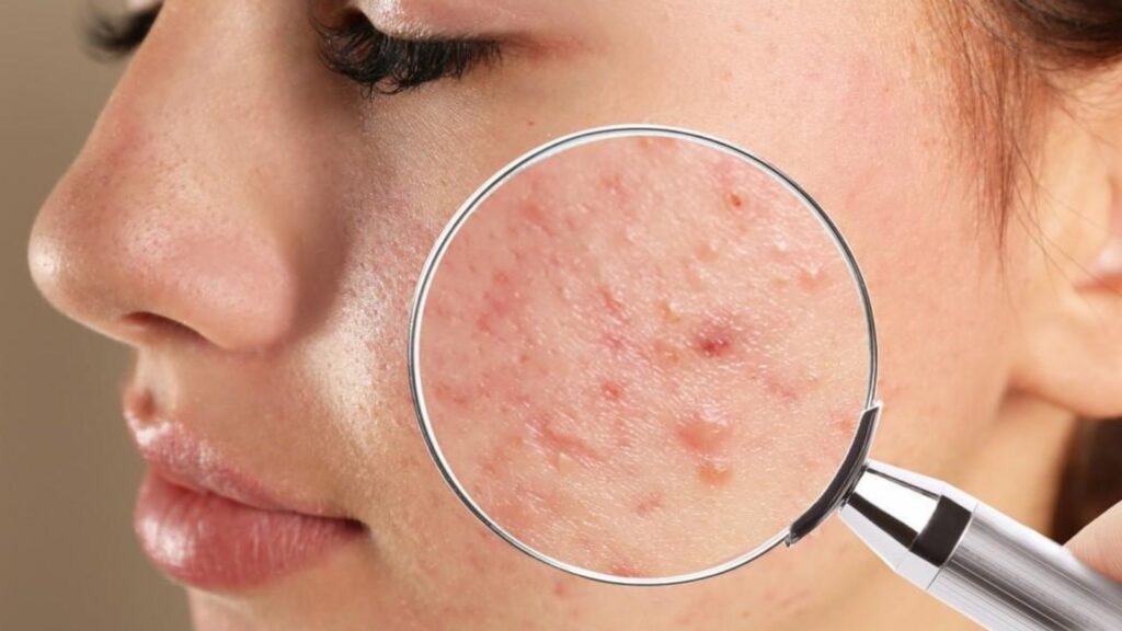 Acne: Causes, Treatments, and Prevention by Dr. Madhavi's Skin Central