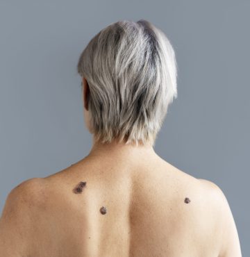 back-view-senior-woman-with-melanoma